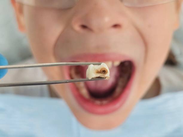 Best Emergency Tooth Extraction in Fountain Inn, SC